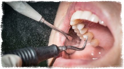 Gingiile sau gingiile au inflamat decât clătirea și ce agenți de utilizat, totul despre dinți