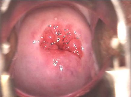 Efectele congenitale ale ectopeniei cervicale, diagnosticul, tratamentul