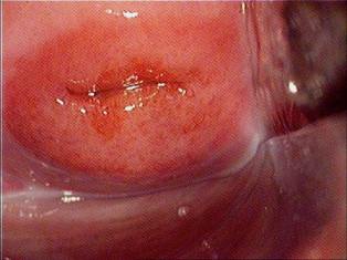 Efectele congenitale ale ectopeniei cervicale, diagnosticul, tratamentul