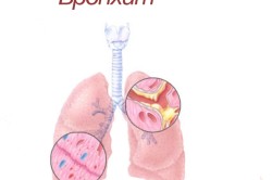Lassú bronchitis tünetek és a kezelés