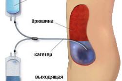 Хронічна ниркова недостатність лікування, симптоми