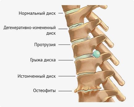 Intervertebral întrebări despre boala discului și răspunsuri