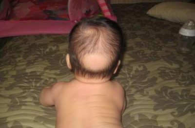 Zalysina în copilul din spatele capului și tratamentul