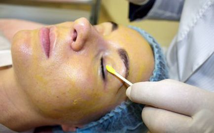 Жовтий пілінг особи проведення процедури і догляд за шкірою