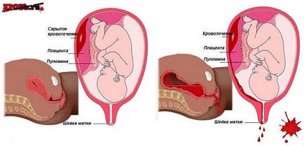 Sângerarea sângerării - tratamentul sângerării