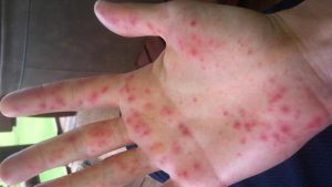 Alergia la frig - simptome și tratament (fotografie)