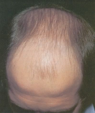 Alopecia androgena la bărbați - cauze, simptome, tratament