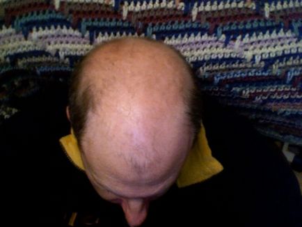 Alopecia androgena la bărbați - cauze, simptome, tratament