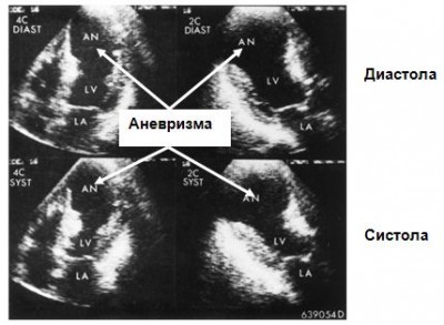 Anevrismul de simptome și tratament al mnp (septal atrial)