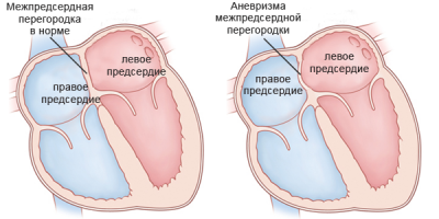 Аневризма мпп (міжпередсердної перегородки) симптоми і лікування