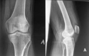 Osteoartrita după faza de fractură, cauze, simptome și tratament