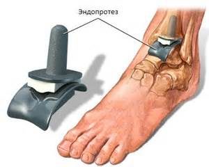 Osteoartrita după faza de fractură, cauze, simptome și tratament