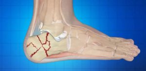 Osteoartrita după faza de fractură, cauze, simptome și tratament