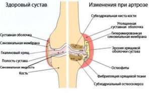 Osteoartrita după faza de fractură, cauze, simptome și tratament
