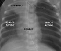 Atelectazia plămânilor la nou-născuți - cauze, simptome, diagnostic și tratament