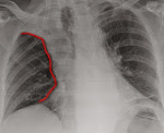 Atelectazia plămânilor la nou-născuți - cauze, simptome, diagnostic și tratament