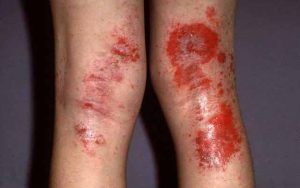 Simptomele dermatitei atopice sau alergice la adulți