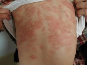 Атопічний або алергічний дерматит симптоми і лікування у дорослих