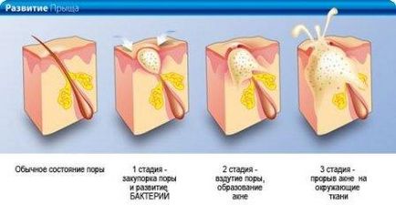 Fehér agyag és acne zsíros bőrre Receptek