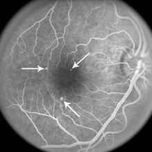 Tratamentul și diagnosticarea centrală a chorioretinopatiei seroase (cps)