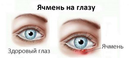 Чим лікують ячмінь на оці у дорослого причини появи і лікування народними засобами, внутрішній