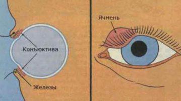 Чим лікують ячмінь на оці у дорослого причини появи і лікування народними засобами, внутрішній