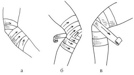 Черепашья пов'язка на ліктьовий суглоб схема правильного накладення