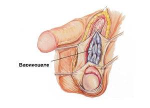 Ce trebuie făcut dacă testicul și durerea abdominală la un bărbat doare, simptomele cu prostatită, umflarea testiculului stâng