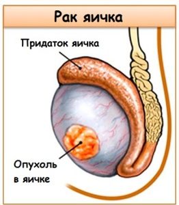 Ce trebuie făcut dacă testicul și durerea abdominală la un bărbat doare, simptomele cu prostatită, umflarea testiculului stâng