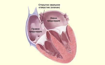 Що таке аневризма мпп, наслідки та методи лікування