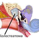 Ce este angina și cum să o tratezi