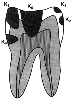 Dental-revue, статті, терапевтична, система класифікацій карієсу