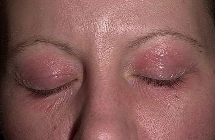 dermatita in jurul ochilor)