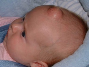 Дермоїдна кіста на голові у дитини, кістаблог