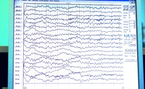 Diagnosticul epilepsiei