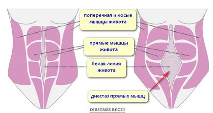 Diastaza de mușchi abdominali rectus după naștere, zaplyushki