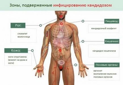 Дієта і лікувальне харчування при кандидозі меню, рецепти, відгуки лікарів