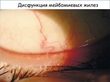 Meibom mirigy diszfunkció (bútorok) Meibom mirigy diszfunkció