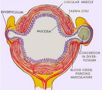 Diverticuloza și diverticulita în uzi (prelegere pe diagnostician)