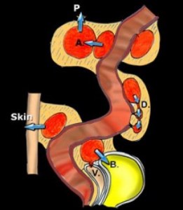 Diverticuloza și diverticulita în uzi (prelegere pe diagnostician)