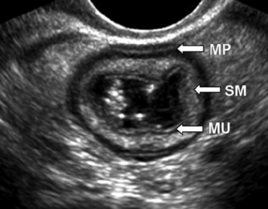 Diverticulosis és diverticulitis az USA-ban (a diagnostere előadás)