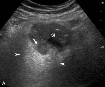 Diverticuloza și diverticulita în uzi (prelegere pe diagnostician)