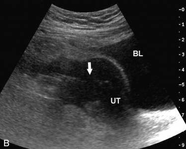 Diverticuloza și diverticulita în uzi (prelegere pe diagnostician)