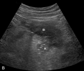 Diverticuloza și diverticulita în uzi (prelegere pe diagnostician)