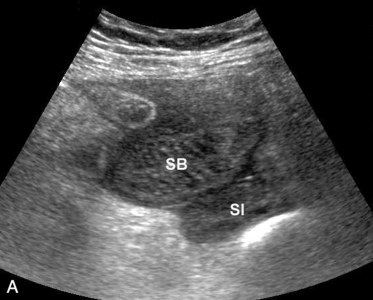 Diverticuloza și diverticulita în uzi (prelegere pe diagnostician)