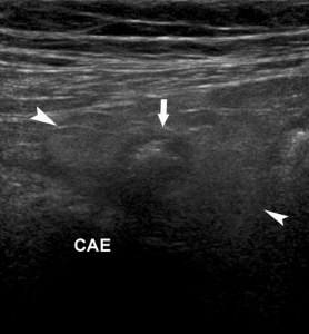 Diverticuloza și diverticulita în uzi (prelegere pe diagnostician)