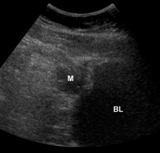 Diverticuloza și diverticulita în uzi (prelegere pe diagnostician)