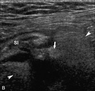 Diverticuloza și diverticulita în uzi (prelegere pe diagnostician)