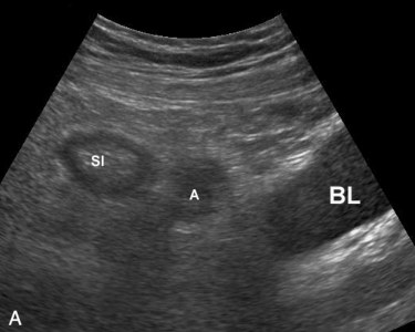 Diverticuloza și diverticulita în uzi (prelegere pe diagnostician)