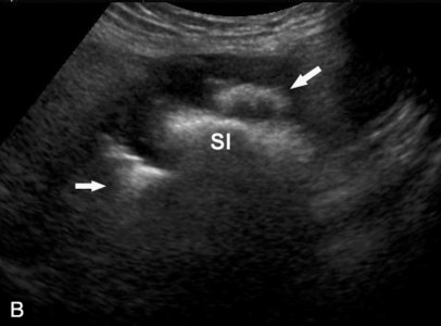 Diverticuloza și diverticulita în uzi (prelegere pe diagnostician)